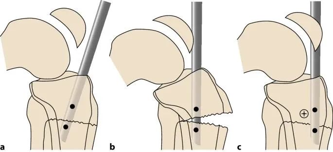 Tibial Fracture Suprapatellar Intramedullary Nailing Technique