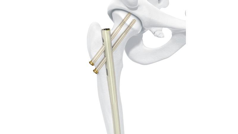 femoral recon nail8X4_0.jpg