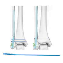 A ye fibular fibular intramedullary nail .
