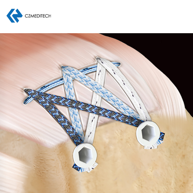 Polyethylene suture ethicon suture 