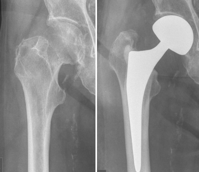 Top 5 hot issues of femoral neck fracture, your peers are dealing with this!