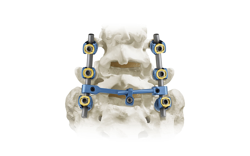 5,5-SPINAL-PEDICLE-SYSTEN
