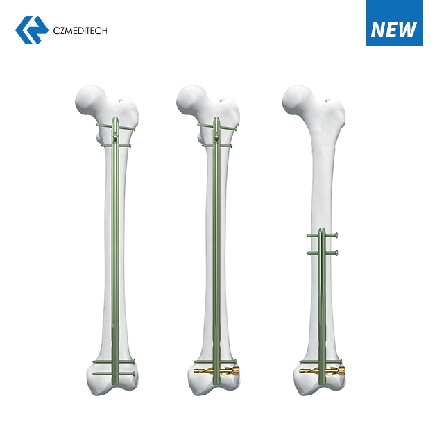 DFN दूरतः Femur IntramedUllary Nail . 
