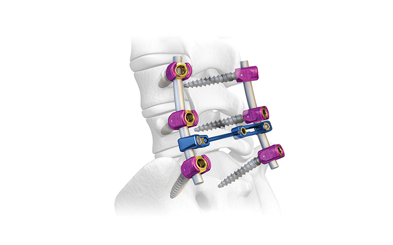 6.0-epinyè-pedicle-vis-sistèm