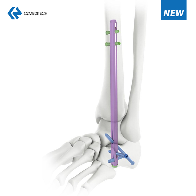 HINDFOOT FUSKK Knach Neel
