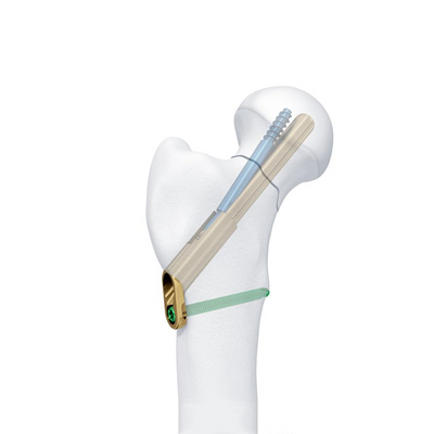 FNS (Femoral Neck System)