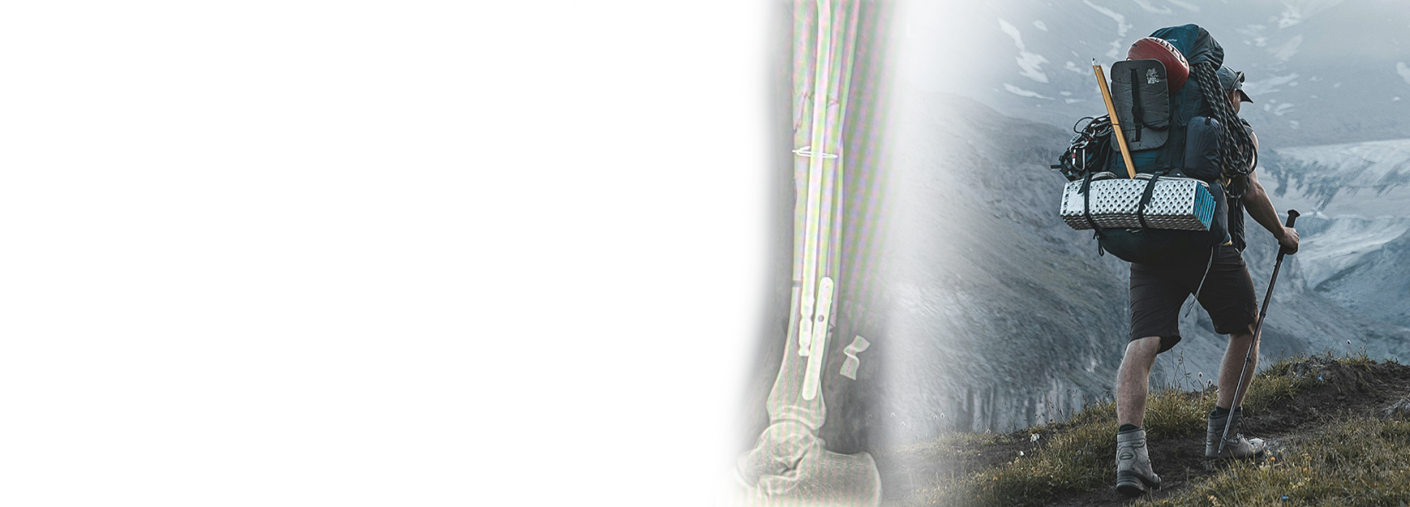 Tibial fracture fixation case in Mexico with tibial nail and circular plate