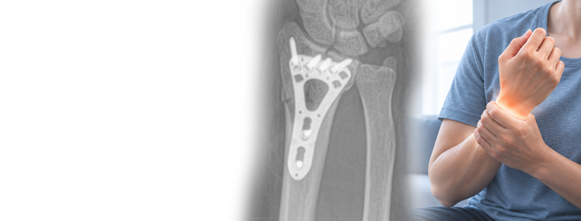 Radius fracture surgery in Mexico